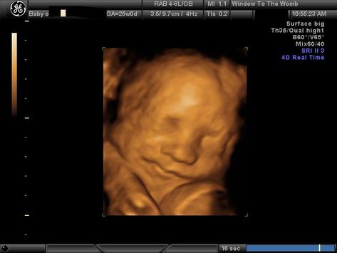 25 week 3d ultrasound images Girl Ultrasound, 3d Ultrasound, Ultrasound Pictures, Ultrasound