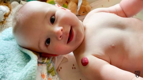 Mayo Clinic Minute: What is this bright red birthmark on my baby? Red Birthmark, Unwanted Hair Growth, Green Side, How Many Kids, Red Marks, Mayo Clinic, Homeopathic Remedies, Baby Born, Blood Vessels