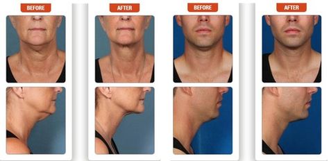 Non Surgical Facelift, Chemical Peels, Cuyahoga Falls, Face Scrub Homemade, Anti Aging Beauty, Peeling Skin, After Pictures, Anti Wrinkle Cream, Chemical Peel