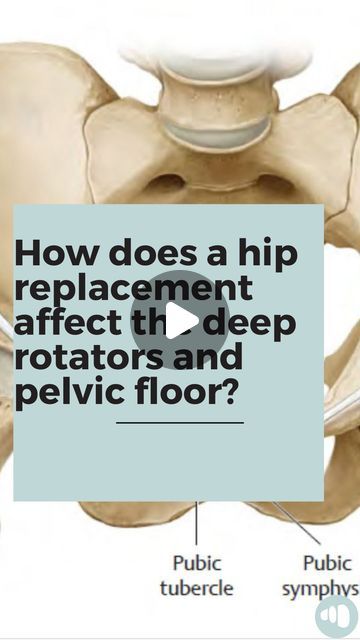 Anatomy of Pilates | MSc Orthopedic Rehab/Adaptive Sports on Instagram: "There are three different approaches to a total hip replacement: anterior approach, lateral approach, and posterior approach. Different approaches have different benefits and risks, but all hip replacements are largely what we would consider successful in terms of addressing the function and pain that tends to precede a hip replacement.   While the modern approach to hip replacements aim to “spare” the muscles around the hip from major disruption, is this always the case? And how does common muscle disruption during hip replacement affect the deep rotators, and possibly the pelvic floor?  The posterior approach, the most common technique worldwide, detaches and repairs the joint capsule as well as the conjoined tendon What Does Hip Abductor Do, Labral Tear Hip Exercises, Hip Exercises After Replacement, Exercises For Hip Impingement, External Hip Rotation, Adaptive Sports, After Surgery, Post Surgery, Hip Pain