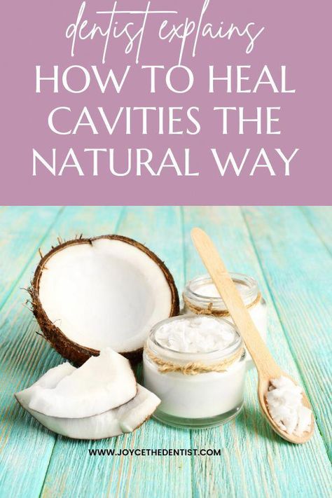 I have such a big cavity and was excited to read it can be reversed naturally! #WhatDoesOralHealthCareMean Cavity Remedy, Natural Remedies For Cavities, Reverse Cavities, Tooth Cavity, Tooth Decay Remedies, Remedies For Tooth Ache, Heal Cavities, Dental Health Care, Dental Cavities