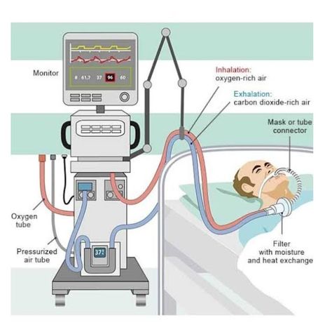 Educatrix: VENTILATOR in Critical Care Hospital Tools, Ventilator Settings, Arterial Blood Gas, Family Nurse Practitioner, Mechanical Ventilation, Types Of Surgery, Hospital Nurse, Chronic Obstructive Pulmonary Disease, Respiratory Therapy