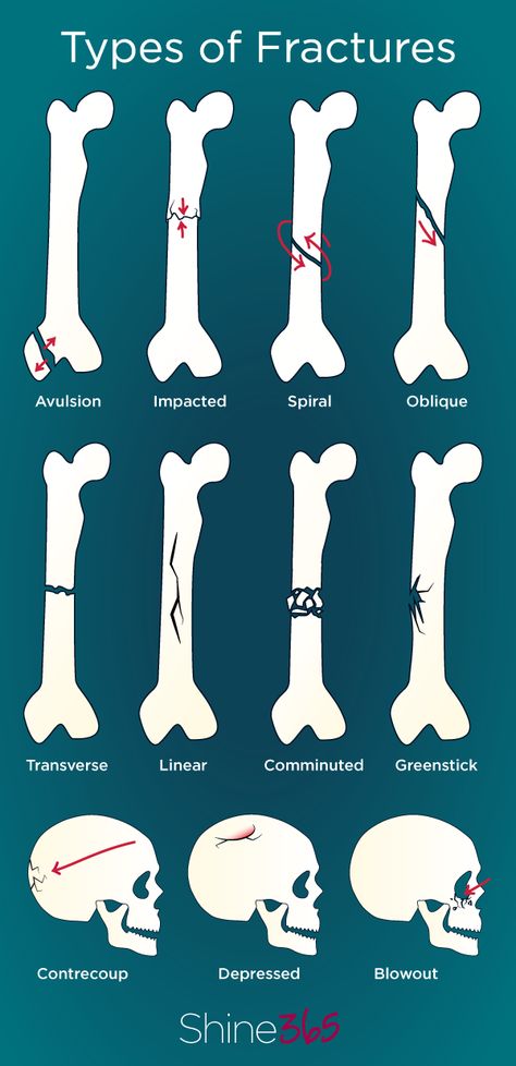 Understand 11 types of bone breaks from Shine365 & Marshfield Clinic Bone Healing Process, X Ray Positioning Chart, Radiology Anatomy, Anatomy Diagrams, Types Of Injuries, Types Of Fractures, Student Quotes, Bone Healing, Types Of Bones