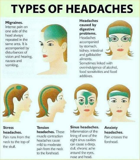 Masher Physio on Instagram: “There are several typical headache. The most common happened is Servicogenic Headaches / Tension headaches . . The pain comes around the…” Migraine Remedies, Migraine Help, Sinus Cavities, Headache Causes, Headache Types, Sinus Headache, Homeopathy Medicine, Migraine Relief, Muscle Contraction