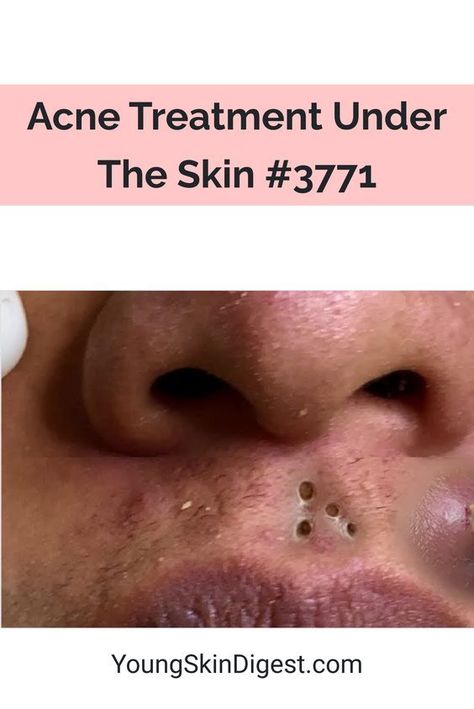 Face Acne Remedies, Under The Skin Acne, Acne Reasons, Pimples Under The Skin, Pimples Remedies, Natural Acne Remedies, Under The Skin, Good Skin Tips, Acne Causes