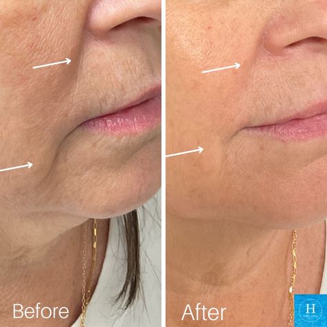 Smooth wrinkles and folds with dermal fillers. Learn all about dermal fillers for your nasal labial folds (around the mouth) and smile lines that we offer at our premier medspa in Bucks County, PA here: #dermalfillers #fillerbeforeandafter #marrionettelinefiller #juvederm #medspa #medicalspa #nonsurgicaltreatment #buckscountypa #buckscountymedspa Nasal Labial Folds Filler, Nasolabial Folds Dermal Fillers, Vogue Pictures, Under Eye Filler, Jawline Filler, Eye Filler, Restylane Lyft, Sagging Cheeks, Cheek Lift