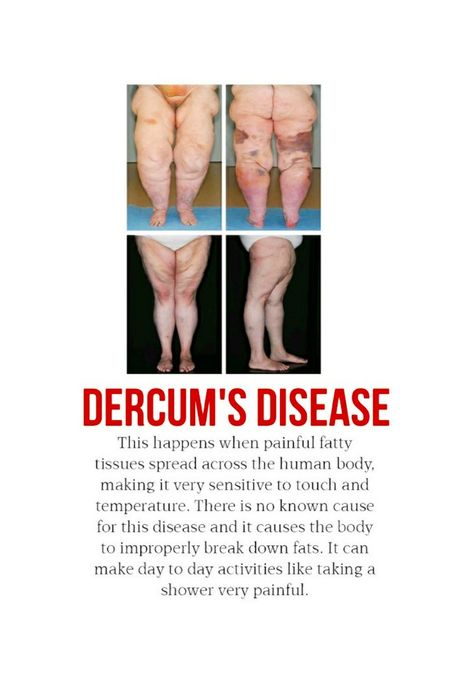 Lipedema Diet, Dercums Disease, Rare Disease, Activity Days, Take A Shower, Disease, Human Body, Medical, Diet