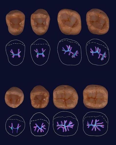 #artificialteeth #composite #amalgam #operative_dentistry Dental Ceramics, Dental World, Dental Restoration, Dental Aesthetics, Dental Videos, Kedokteran Gigi, Dental Health Care, Dental Hygiene School, Dental Anatomy