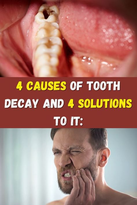 Grow Back Receding Gums, Tooth Decay Remedies, Remedies For Tooth Ache, Teeth Health, Tooth Pain, Stronger Teeth, Oral Care Routine, Receding Gums, Oral Health Care