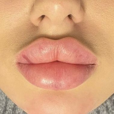 Botox Nurse Aesthetic, Full Lips Aesthetic, Desired Lips, Lip Goals, Moon Sagittarius, Diy Lip Plumper, Juvederm Lips, Big Lips Natural, Lips Inspiration