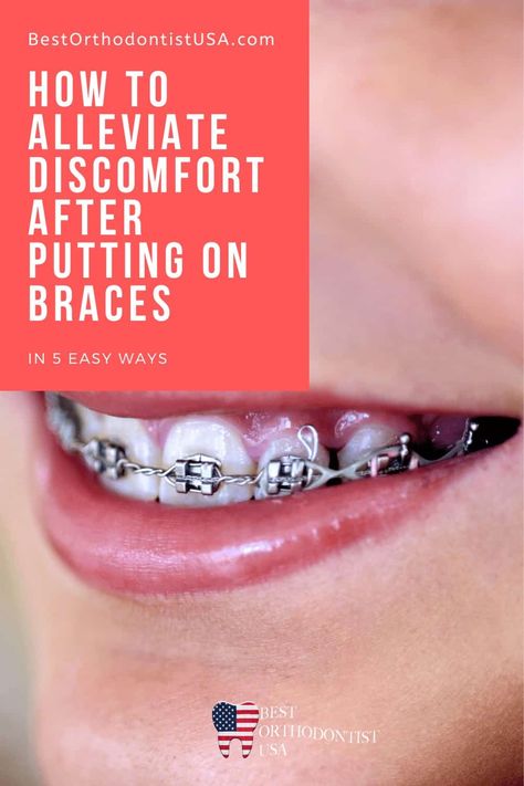 Teeth After Braces, Diy Braces, Fixed Braces, Braces Food, After Braces, Braces Bands, Braces Cost, Adult Braces, Kids Braces