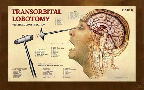 Bone Healing, Frontal Lobe, Ice Pick, Sucker Punch, Vintage Medical, Post Traumatic, Anatomy, Brain, Medicine