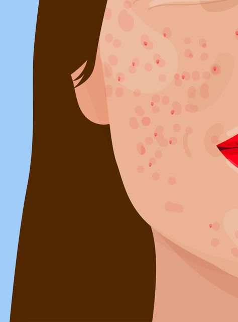 Body Positivity Art, How To Get Rid Of Pimples, Beauty Posters, Illustration Art Girl, 수채화 그림, Beauty Illustration, Feminist Art, Art And Illustration, Body Positivity