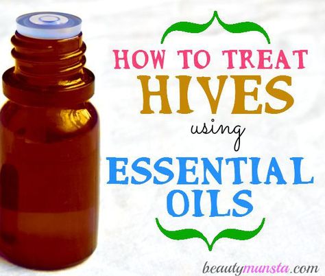 Here are 5 of the best essential oils to treat hives plus effective recipes that really work in soothing & calming those itchy hives! Essential Oil For Hives, How To Treat Hives, Hives Remedies, Natural Beauty Hacks, Essential Oils For Colds, Aromatherapy Recipes, Essential Oils For Headaches, Essential Oils Health, Yl Essential Oils