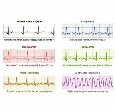 Heart Physiology, Cardiac Arrhythmias, Teas 7, Er Tech, Ekg Interpretation, Normal Sinus Rhythm, Basic Anatomy, Air Force Day, Medical Study