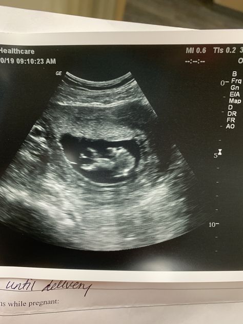 1st ultrasound of baby girl! Ultrasound Pictures 1 Month, Ultrasound Pictures 2023, 3 Month Ultrasound Pictures, Fake Ultrasound Pictures 4 Weeks, Fake Ultrasound Pictures 2023, First Ultrasound Picture Ideas, 3 Month Ultrasound, Fake Ultrasound Pictures, 5 Week Ultrasound Pictures