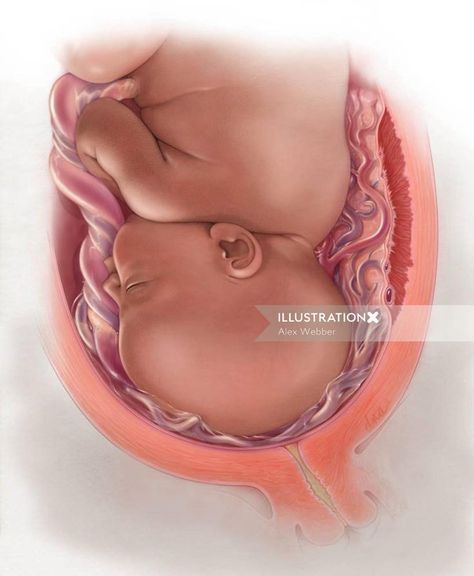 Late stage of pregnancy shown with Vasa Previa from an abnormal placenta with a vellamous attachment. Vasa Previa, Exam Pictures, Baby In Womb, New Baby Pictures, Trendy Baby Shoes, Best Baby Cribs, Christmas Baby Announcement, Baby Boy Pictures, Lifestyle Illustration