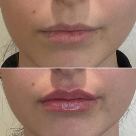 Bow Shaped Lips Filler, Injection Image, Cupid Bow Lips Filler, Defined Cupids Bow Lip Filler, Lip Filler Inspo 0.5ml, Lip Filler 0.5ml, B12 Injections, Botox Filler, Skin Care Pictures