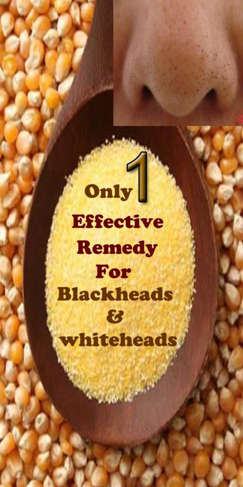 I am going to tell you how you can get rid of your blackheads and whiteheads permanently. Use this one ingredient to get rid of blackheads. Trust me, this remedy actually works to remove blackheads and whiteheads.Try it Whiteheads Removal Remedies Home, Whiteheads Removal Remedies, How To Get Rid Of Blackheads, How To Remove Whiteheads, Natural Blackhead Remover, Remove Whiteheads, Whiteheads Removal, Facial Remedies, Blackhead Remedies