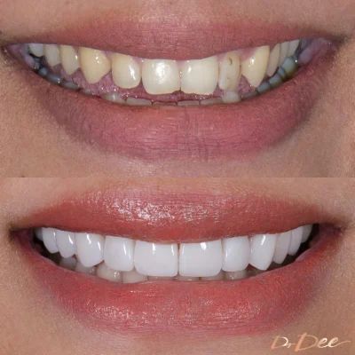 Our results gallery shows before and after images for treatments such as porcelain veneers, Invisalign Lite, Invisalign Full, teeth whitening, and gum laser surgery, Composite Veneers, Clear Braces, Dental Design, Straight Teeth, Laser Surgery, Porcelain Veneers, Dental Center, General Dentistry, Smile Design