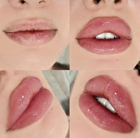 Lip Filler Inspiration, Italian Outfits Women, Rhinoplasty Nose Jobs, Lips Inspiration, Botox Lips, Pretty Nose, Fuller Lips, Facial Aesthetics, Lip Filler