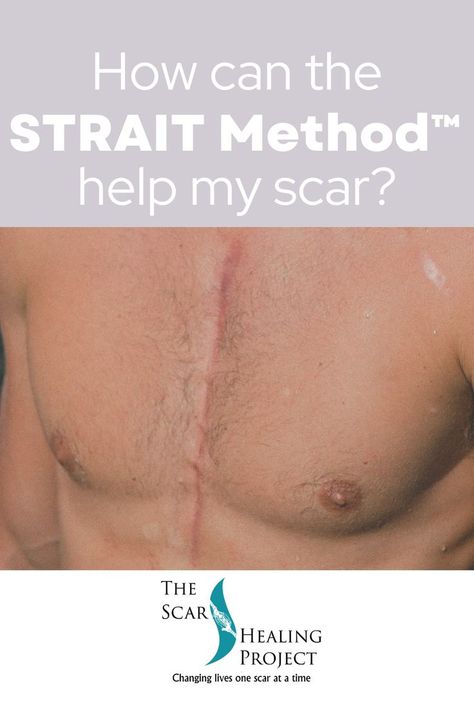 STRAIT Method™ therapy begins with a series of fascial techniques that release and realign the restrictive tissue from the starting point (visible scar) to the endpoint (where the line of frozen fascia stops). You experience relief from the years of pain you’ve endured by finally addressing your adhesions and scars. #thescarhealingproject #scars #straitmethod #massagetherapy #massage #clinicalmassage #scartissuerelease #scartherapy #healingfromscars Body Mechanics, Scar Tissue, Balanced Life, Holistic Approach, Healing Journey, Mental Wellness, Massage Therapy, Life Balance, Mind Body