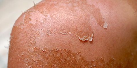 Skin Peeling: How to stop it and protect yourself from sunburns Burns On Skin, Severe Sunburn, How To Treat Sunburn, Hangover Headache, Sunburn Peeling, Bad Sunburn, Sunburn Skin, Sunburn Remedies, Aloe Vera Benefits