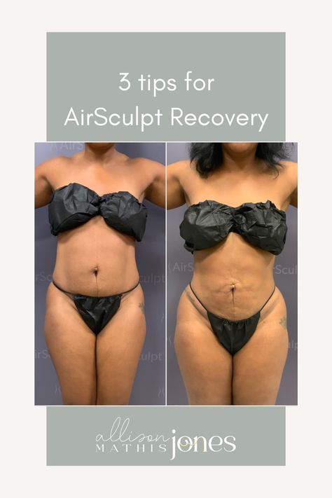 I recently had AirSculpt liposuction done and am in love with the results. Here are my tips for recovery in the first 90 days! Air Sculpting Before And After, Airsculpt Before And After, First 90 Days, The First 90 Days, Facial Routines, Compression Garment, Loose Skin, The Staff, Above And Beyond