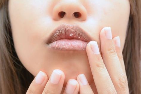 Dry Lips Remedy, Lip Exfoliator, Cracked Lips, Beauty Tips For Face, Natural Exfoliant, Cold Sore, Dark Lips, Homemade Remedies, Chapped Lips