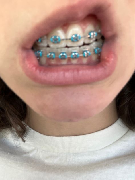 Teal Braces Aesthetic, Aqua Braces, Turquoise Braces, Teal Braces, Brackets Aesthetic, Light Blue Braces, Braces Aesthetic, Braces Colours, Braces For Teeth