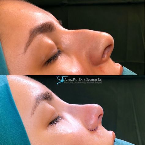 Bulbous Tip Rhinoplasty, Tip Rhinoplasty, Nose Plastic Surgery, Crooked Nose, Bulbous Nose, Nose Tip, Nose Jobs, Rhinoplasty Nose Jobs, Aesthetic Dermatology