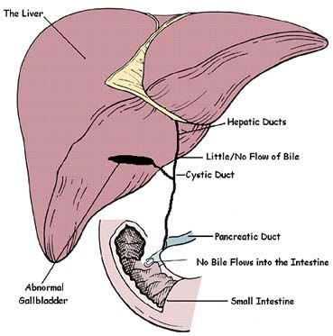 biliary atresia Biliary Atresia, Board Exam, Exam Prep, Pediatric Nursing, Level 3, Baby Things, Nursing School, Pediatrics, Nursing