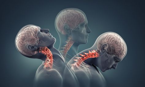 Overview: Craniocervical Instability and Related Disorders - Chiari Bridges Bones Of The Head, Whiplash Injury, Cervical Vertebrae, Neck Injury, Icd 10, Spine Health, Cervical Pillows, Chiropractic Care, Whiplash