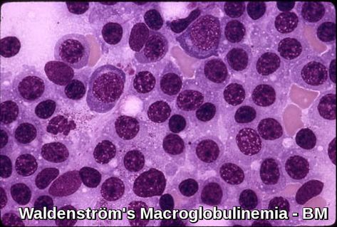 Waldenström's macroglobulinemia, also known as Lymphoplasmacytic Lymphoma, is an indolent B-small lymphocyte malignancy with over production of clonal IgM. Flow Cytometry, B Cell, Bone Marrow, Traditional Medicine, Psychiatry, Alternative Medicine, Medicine