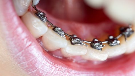 Lingual Braces: Pros and Cons, Cost, Comfort, Lisping, and More Permanent Retainer, Braces Before And After, Fixed Braces, Lingual Braces, Braces Cost, Types Of Braces, Adult Braces, Traditional Braces, Orthodontic Appliances