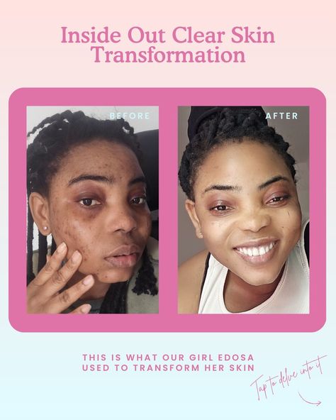 If you are looking to achieve a total clear skin transformation like or girl Edosa, then swipe to see exactly what she used 👉 - Shop via the link in our bio @kallistia Skin Transformation, Clear Skin, Skin, Quick Saves