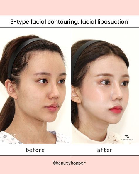 Facial contouring surgery can help create a more balanced and attractive look by reshaping the bones in your face 🧚‍♀️  Common procedures include cheekbone reduction, jaw reduction, & chin reshaping. These will be customised to your specific needs and combined for the best results👍🏻 Although the recovery period to see full results can be lengthy, many patients find the permanent results well worth it✨ Let us help you plan a safe and successful plastic surgery trip to Korea  ❤️ For all inqu... Chin Reduction Surgery, Facial Contouring Surgery, Cheekbone Reduction, Chin Surgery, Trip To Korea, Chin Reduction, Plastic Surgery Korea, Jaw Surgery, Facial Contouring