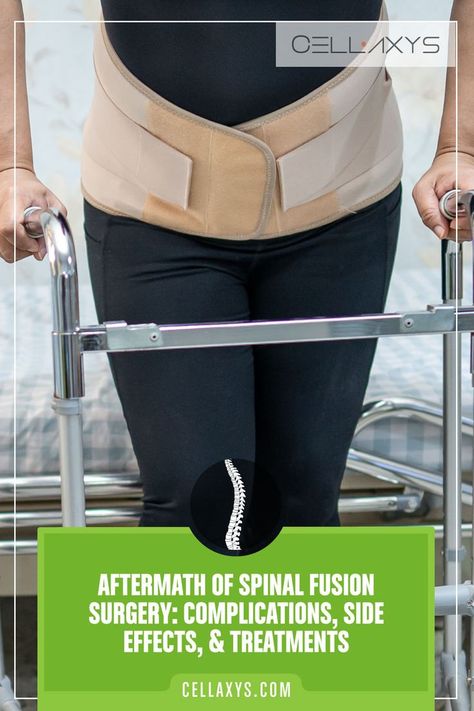 Aftermath of Spinal Fusion Surgery Complications, Potential Side Effects, Treatments Spinal Fusion Surgery, Sciatic Nerve Relief, Sciatic Nerve Pain Relief, Spinal Fusion, Piriformis Stretch, Spinal Surgery, Spinal Injury, Spine Health, Spine Surgery