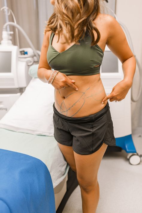 My First CoolSculpting Experience - Haute Off The Rack Airsculpt Before And After, Cool Sculpting Before And After, Coolsculpting Results, Coolsculpting Before And After, Fat Before And After, Aesthetic Medical, Louisiana Fashion, New Orleans Fashion, Ideal Image