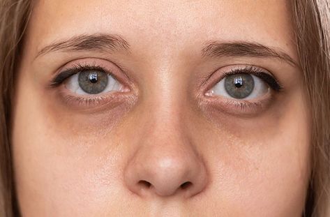 Dark Circles Under the Eyes: Causes and Treatments Dark Under Eye, Dark Circles Under Eyes, Remove Dark Circles, Undereye Circles, Eye Bags, Reduce Wrinkles, Eye Care, Dark Circles, Green Eyes