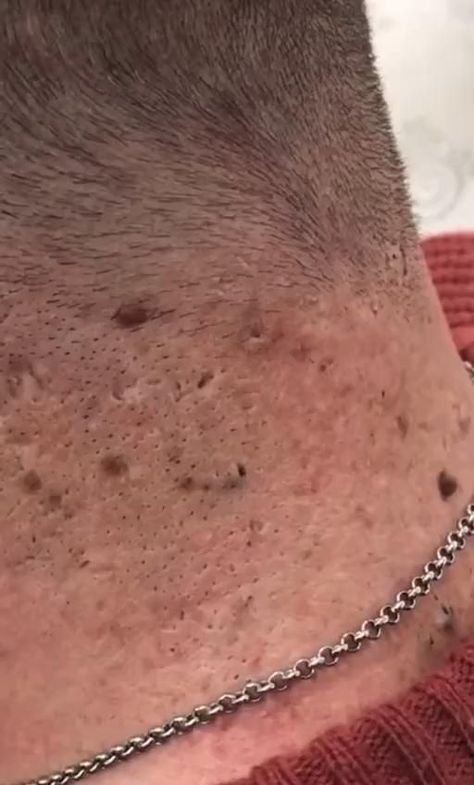 Blackheads Pimple Poppìng Videos, Huge Pimple, Squeezing Blackheads, Architect Ideas, Popping Pimples, Zit Popping, Blind Pimple, Home Remedies For Pimples, Blackhead Extraction