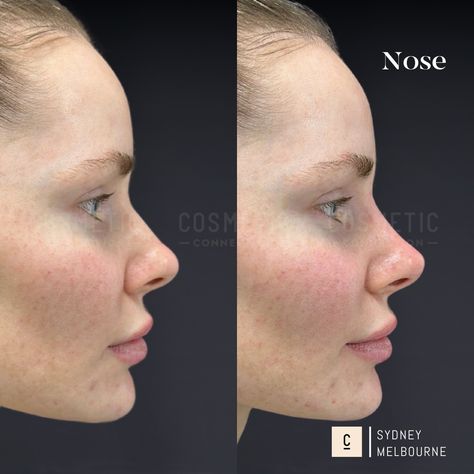 NON-SURGICAL RHINOPLASTY We offer non-surgical consultations for reshaping your nose, to address concerns such as: * A dorsal hump and bumps * Unprojected, undefined noses * Short noses * Hooked nose with a droopy tip * Round or bulbous nose tip * Ski-slope nose * High riding or retracted columella * High riding nostrils * Flaring nostrils * Crooked, bent, and deviated nose * Unsatisfactory surgical rhinoplasty result Want to know if this is an option for you? Comment 'NOSE' to claim your ... Neck Lift Surgery, Double Chin Reduction, Nose Fillers, Nose Tip, Hooked Nose, Bulbous Nose, Crooked Nose, Nose Jobs, Chin Augmentation