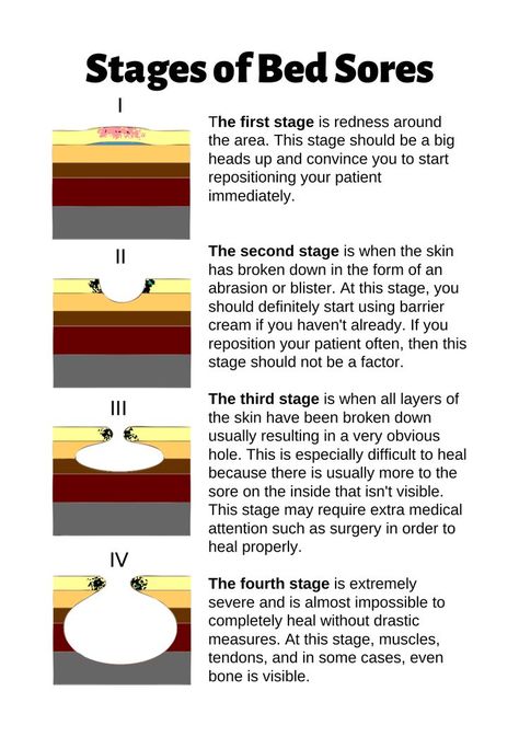 This infographic explains the four stages of bed sores also known as pressure ulcers which is the breakdown of skin when patients are on bedrest or immobile for long periods of time and are not repositioned properly or often enough. Nursing School Studying Cheat Sheets, Nurse Skills, Bed Sores, Pressure Ulcer, Natural Remedies For Migraines, Certified Nursing Assistant, School Info, Nursing School Notes, Medical School Essentials