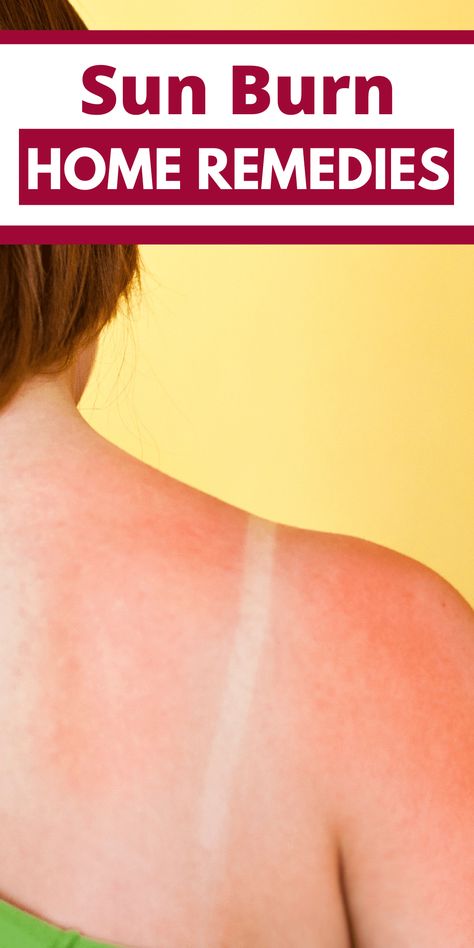 7 Home Remedies for Sunburn | Midwest Modern Momma Help Sunburn, How To Help Sunburn, Remedies For Sunburn, Home Remedies For Sunburn, Severe Sunburn, Sunburn Remedies, Makeup Shades, The Sting, Aloe Plant