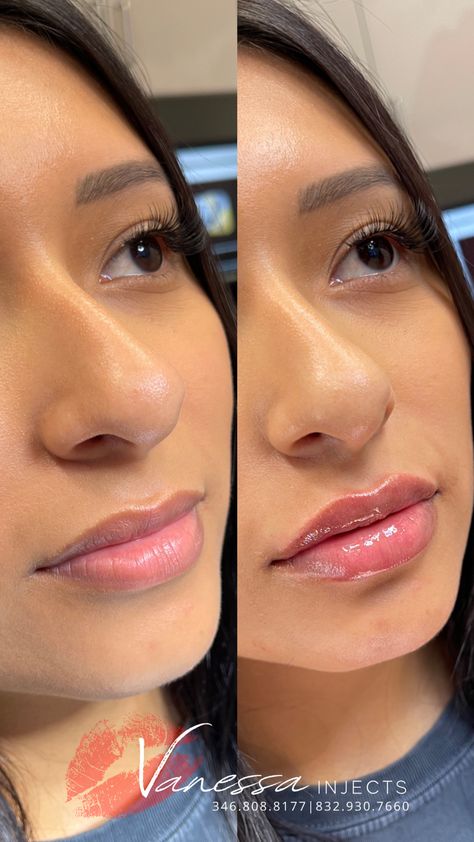 Lip Filler Inspiration 1ml, Lip Filler Before And After 1ml, Lipfiller Before After, 1ml Lip Filler Before And After, Natural Lip Fillers Before And After, 0.5 Lip Filler Before And After, Half Syringe Lip Filler Before And After, Lip Fillers Before And After, 1 Ml Lip Filler Before And After