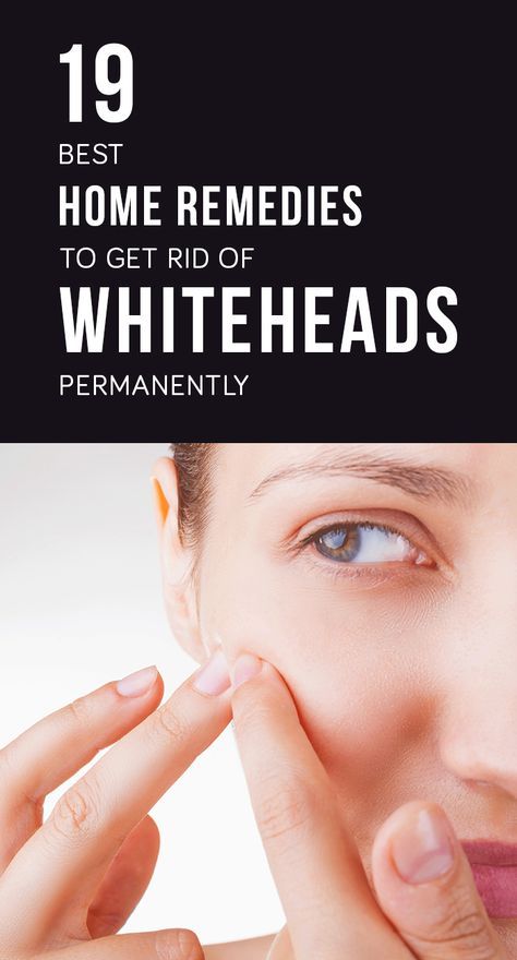 Whiteheads Remedy, Warts On Face, Skin Care Routine For 20s, Fall Makeup Looks, Anti Aging Tips, Simple Skincare, How To Apply Makeup, Skin Care Regimen, Home Remedies