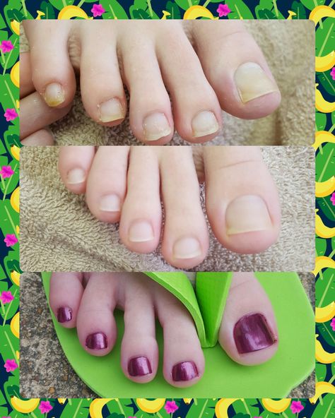 Spa pedicure. Before, during & after shaping & polish Pedicure Before And After, Spa Pedicure, Toe Nail Color, Pedicures, Nail Color, Toe Nails, Makeup Nails, Womens Flip Flop, Nail Colors