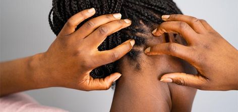 Do you dread dry scalp? Learn how essential oils can help nourish your scalp and prevent dry flakes that are signature of dandruff. Dry Scalp Remedy, Scalp Itch, Honey Shampoo, Flaky Scalp, Baked Tomatoes, Itchy Scalp, Scalp Health, Scalp Conditions, Healthy Scalp