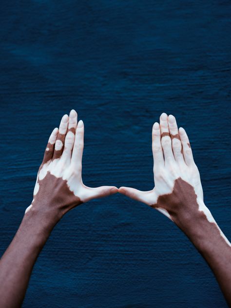 Vitiligo hand gestures w/ @yvesmark.chery ✌🏽✊🏽🖖🏽🖐🏽🙏🏽 I have several friends with vitiligo. I believe it would be inspiring to everyone with vitiligo to see themselves represented even in small detailed things such as emoticons. Everyone deserves a voice, and everyone should feel confident in their skin to speak their truths. #shareblackstories #shareyourstory @instagram @creators @apple @vogue . #vitiligo #vitiligoawareness #vitiligomodel #vitiligobeauty #vitiligoworld #markelzey #yvesma Vilitigo Skin Art, Hands Reference Drawing, Yvesmark Chery, Vilitigo Skin, Virtillago Skin, Vitíligo Oc Female, Vitíligo Black Woman, Everyone Deserves A Voice, Hands Reference