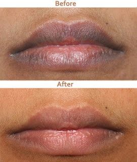 How To Get Rid Of Dark Lips Naturally? Remedies For Dark Lips, Lips Wallpaper, Lip Lightening, Beauty And Makeup, Lightening Creams, Beauty Mask, Black Lips, Beauty Remedies, Dark Lips